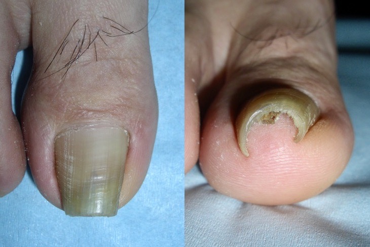 Step By Step 手術手技 陥入爪 部分抜爪