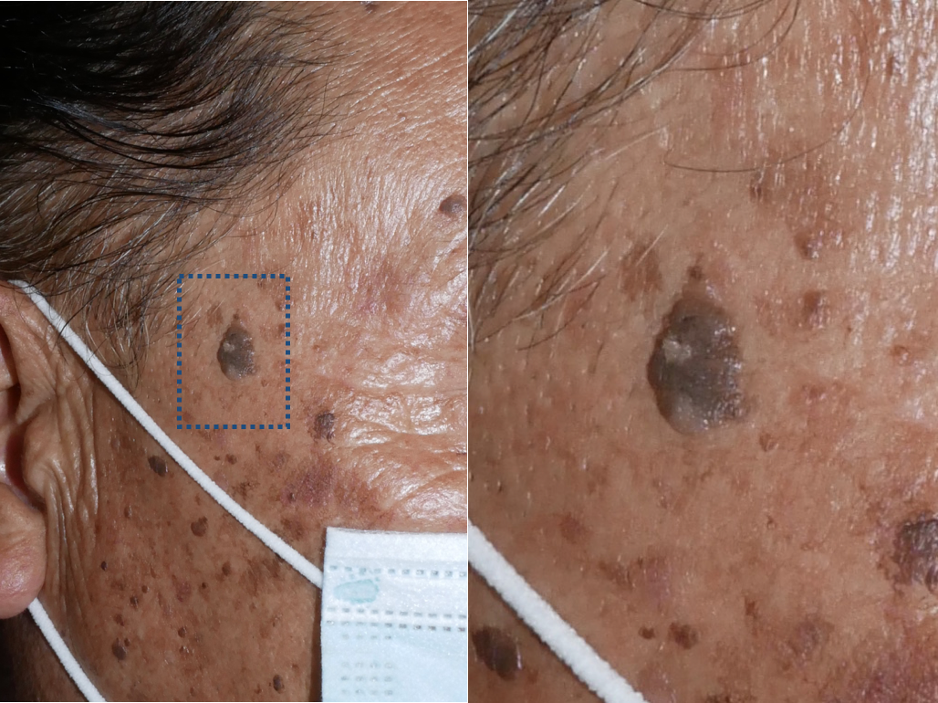 ケラトアカントーマの原因は何ですか?