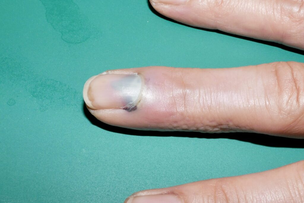 疼痛を伴う爪下血腫の臨床写真