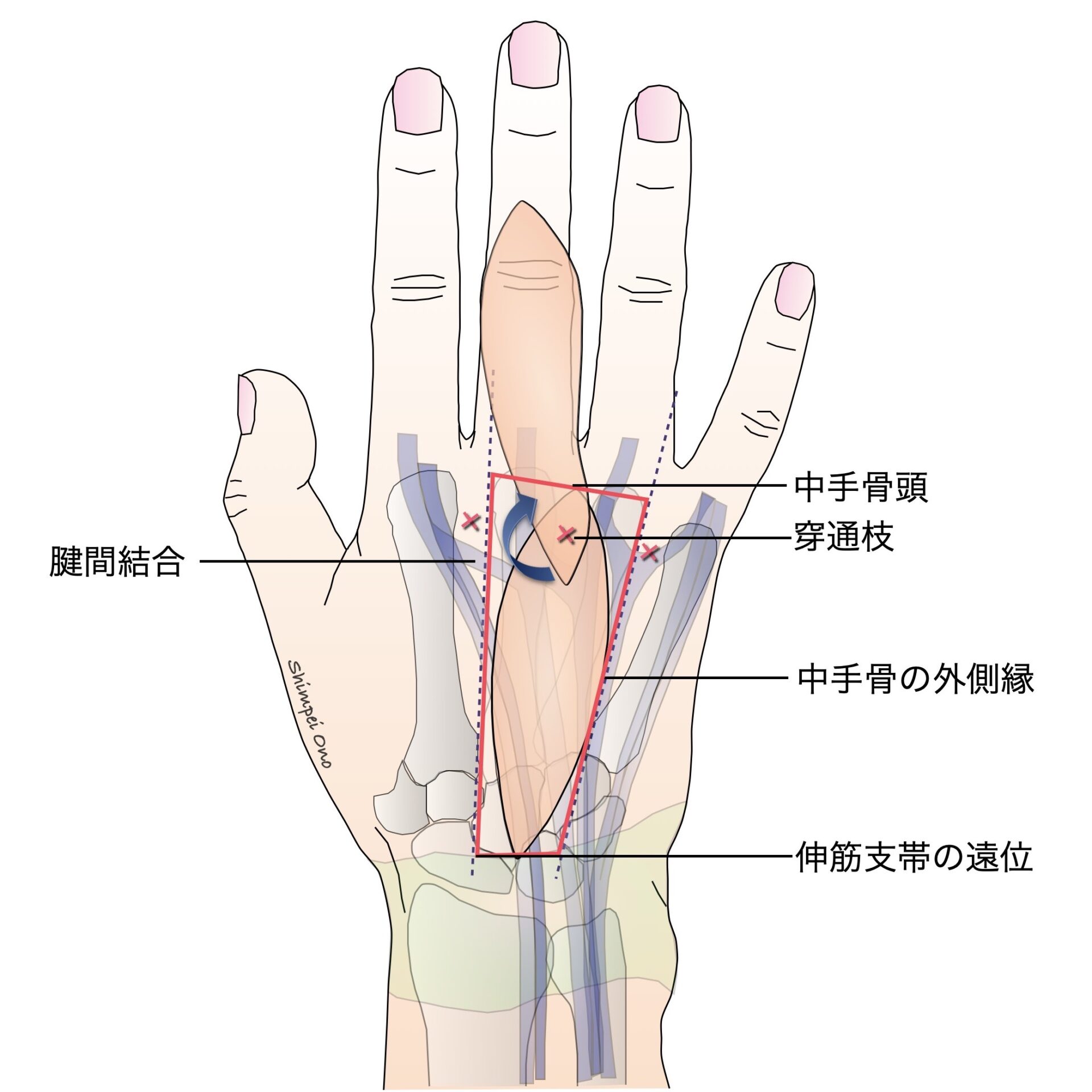 Step by Step 手術手技】指背欠損の再建に有用なDMAP flap - マイナー