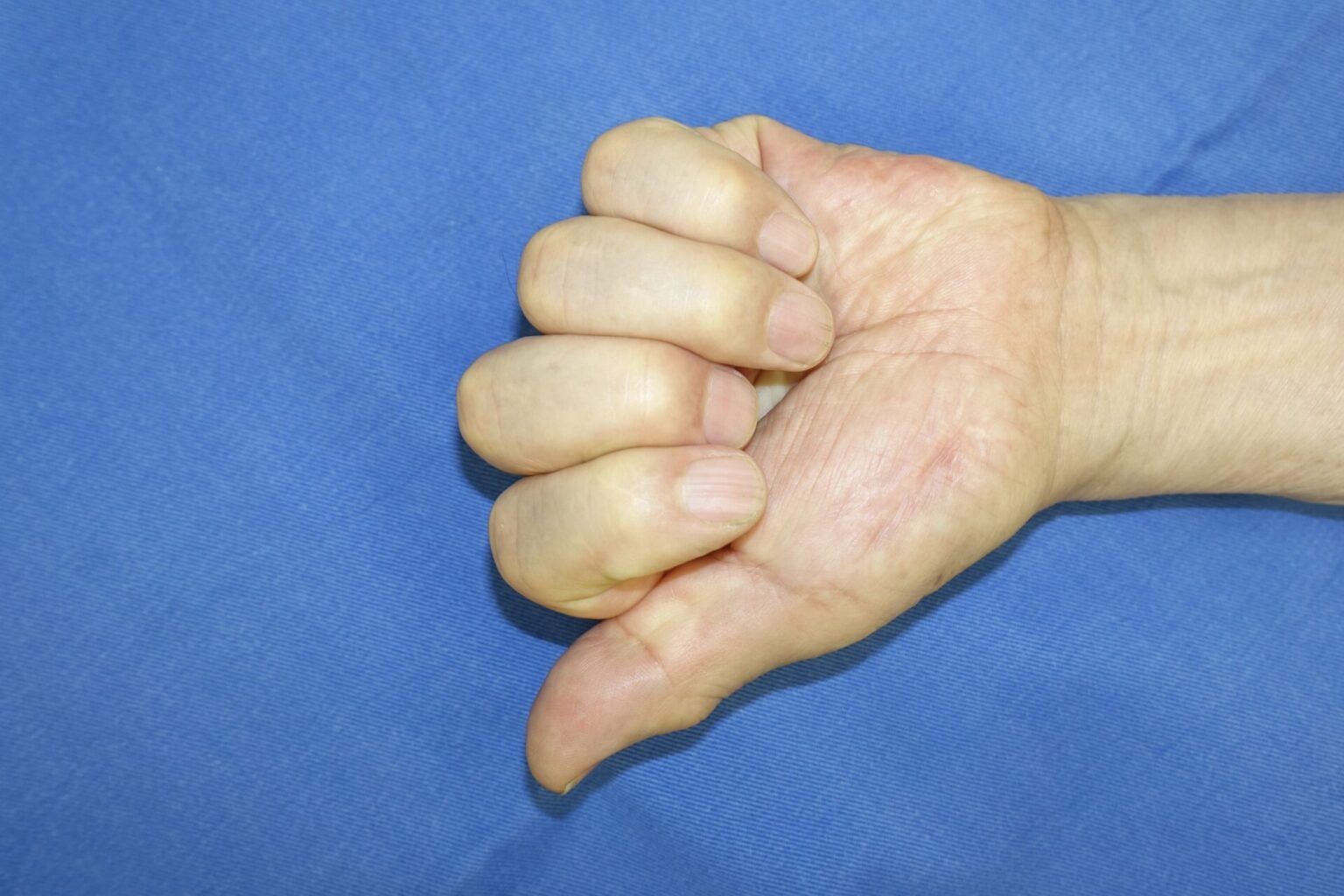 手指再造-外科学-医学