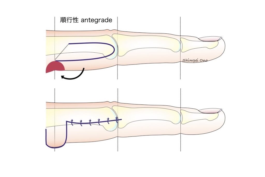 Step By Step 手術手技 指瘢痕拘縮にdigitolateral Flap