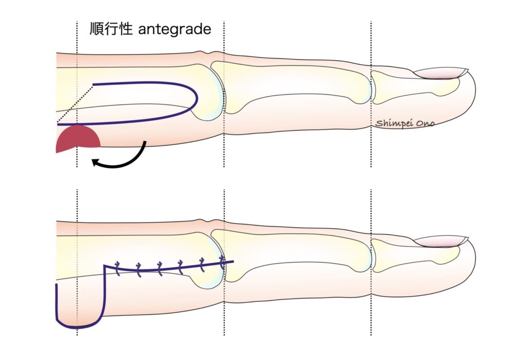 Step By Step 手術手技 指瘢痕拘縮にdigitolateral Flap