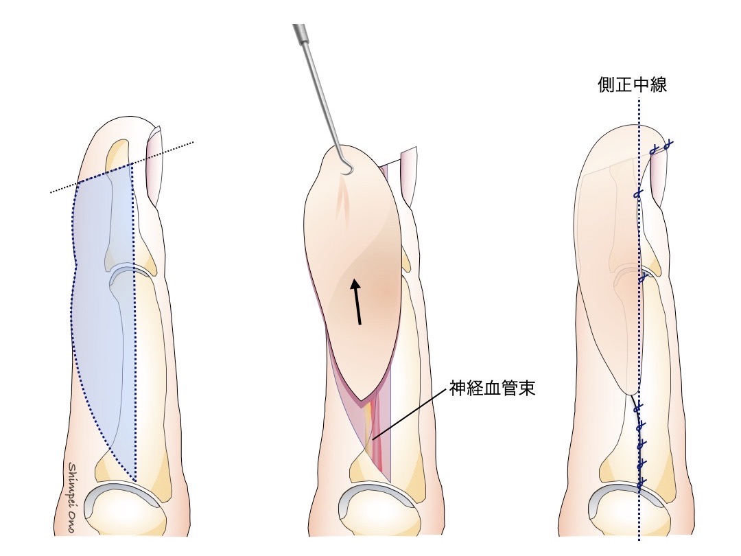 Step by Step 手術手技】Oblique triangular flap - マイナー外科・救急