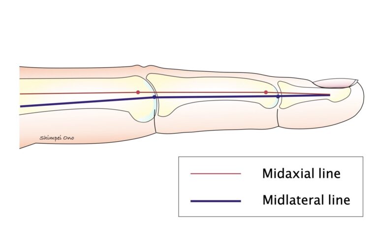 【診療Tips】手指手術の切開法：Bruner's incision、Midlateral incision