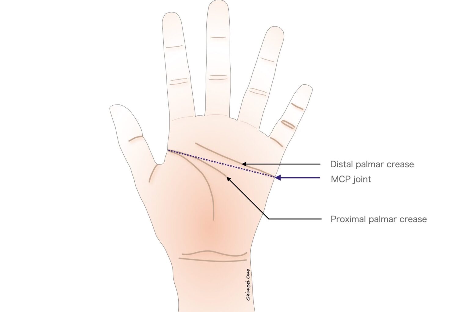 【Clinical Tips】Anatomy: Hand and Finger Creases - マイナー外科・救急