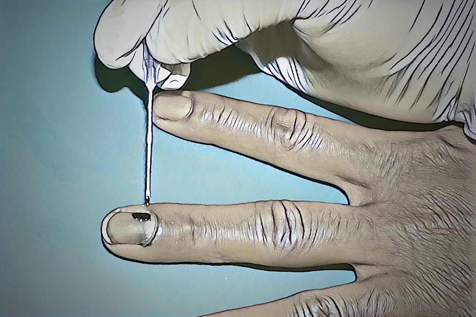 診療tips 爪が生え代わるまでの時系列写真