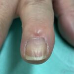 粘液嚢腫と爪の陥凹変形