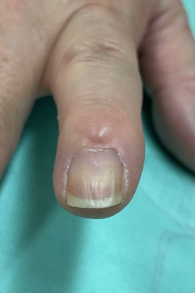 粘液嚢腫と爪の陥凹変形