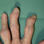 手指の変形性関節症：関節周囲に腫れや変形がみられる