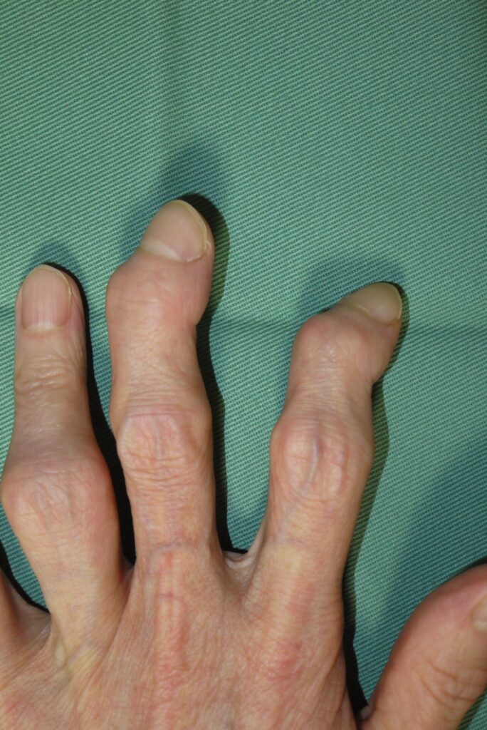 手指の変形性関節症:関節周囲に腫れや変形がみられる