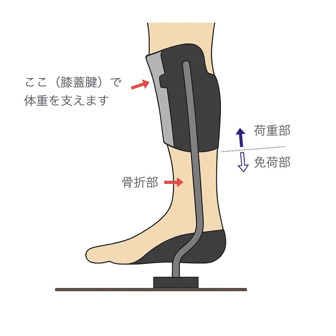 診療Tips】PTB装具とは？膝下で体重を支え足部を守る免荷装具の仕組み