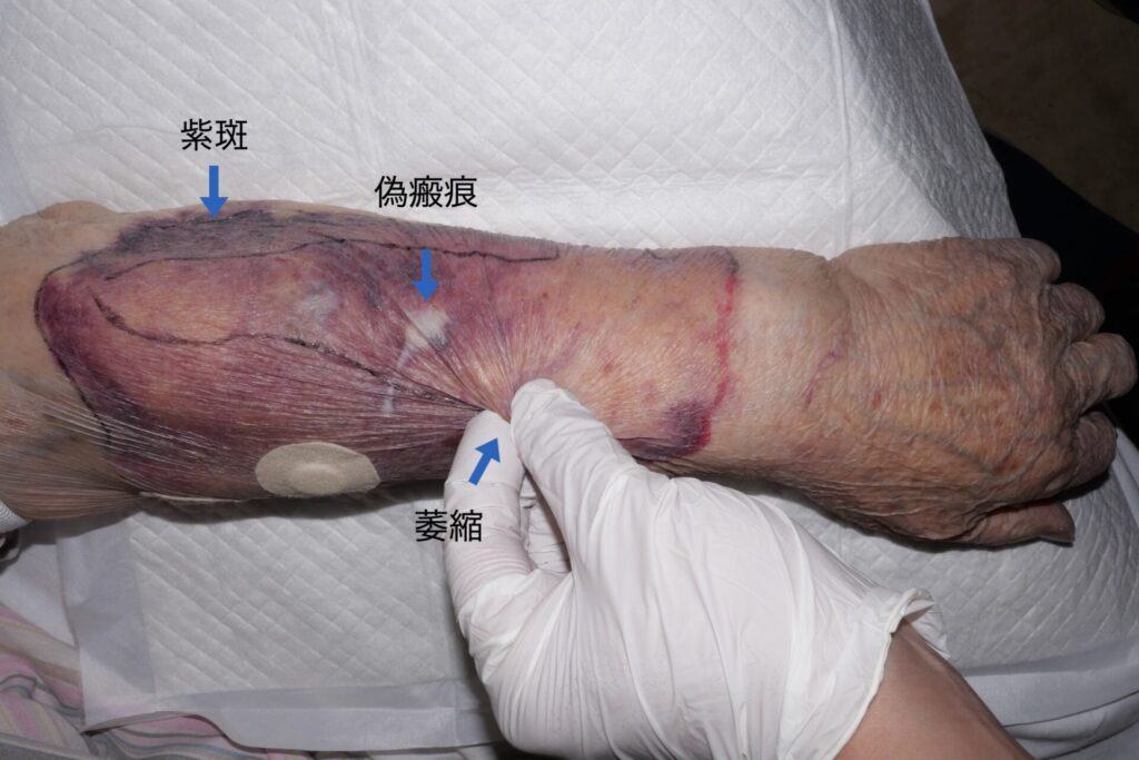 典型的な皮膚粗鬆症（紫斑、偽瘢痕、萎縮）