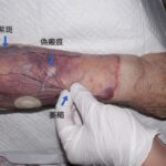 典型的な皮膚粗鬆症（紫斑、偽瘢痕、萎縮）