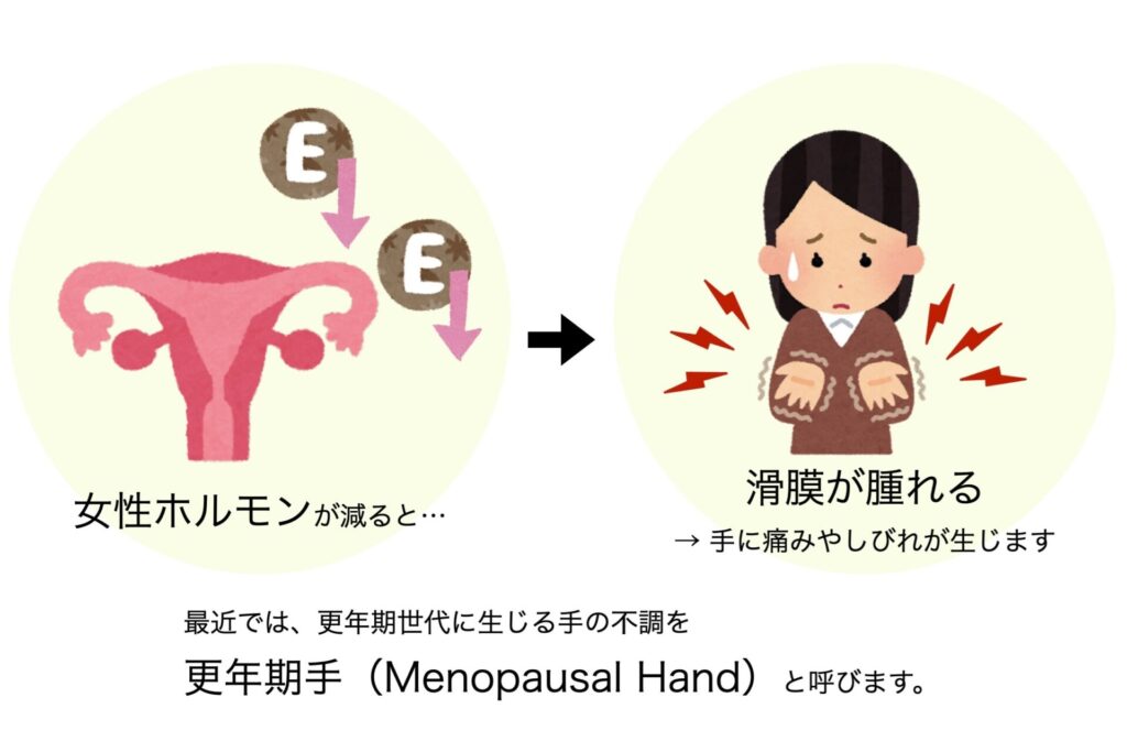 女性ホルモン低下による滑膜炎と更年期手(Menopausal Hand)